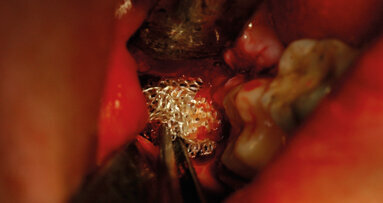 Agenti emostatici locali di sintesi a base di cellulosa ossidata rigenerata