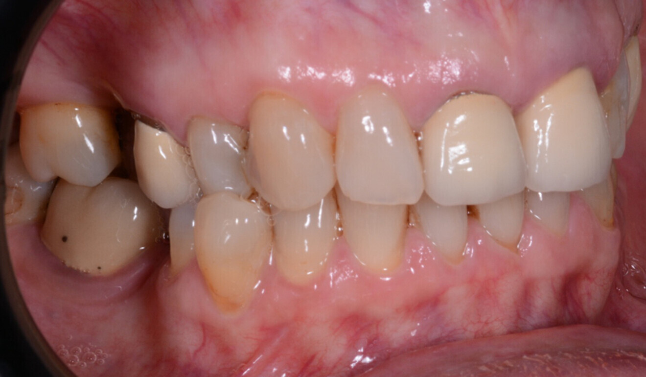 Fig. 3: Lateral view of the maxillary and mandibular right quadrants.
