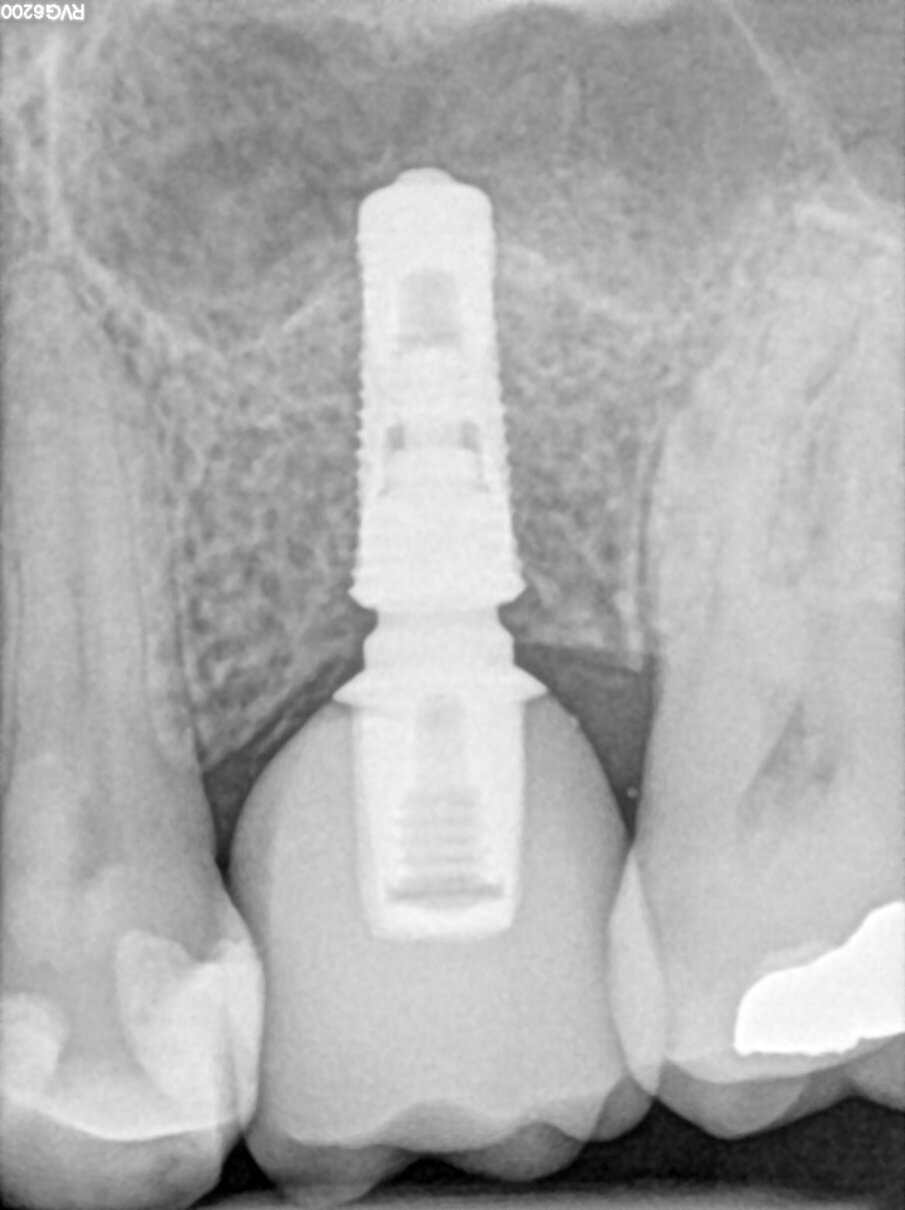 Fig. 11_Follow-up radiografico a 6 mesi.