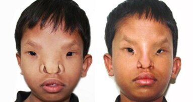 Момче възстанови зрението си след операция на лицето