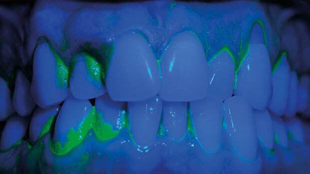 Lo sbiancamento professionale, forza trainante nella concordance sul miglioramento del controllo del biofilm batterico domiciliare