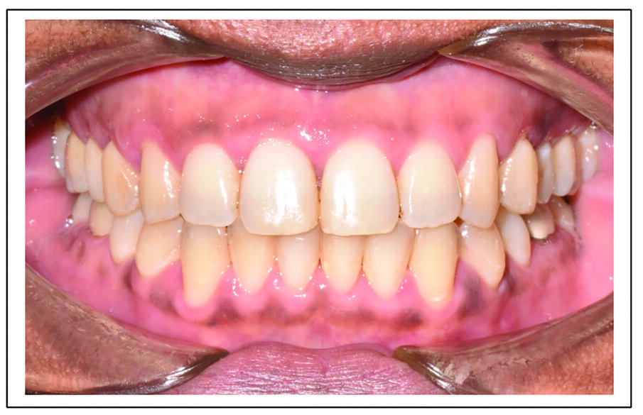 Fig. 13b. Patient S. P. post-treatment after 7.75 months and five appointments of treatment with Spark clear aligners. (Note: Actual patient images, which have not been altered. Patient results may vary.)