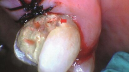 Ablacja twardych i miękkich tkanek jamy ustnej za pomocą lasera Solea CO2 o długości fali 9,3 µm
