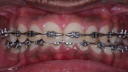 Innovative coating on dental appliances prevents bacterial growth