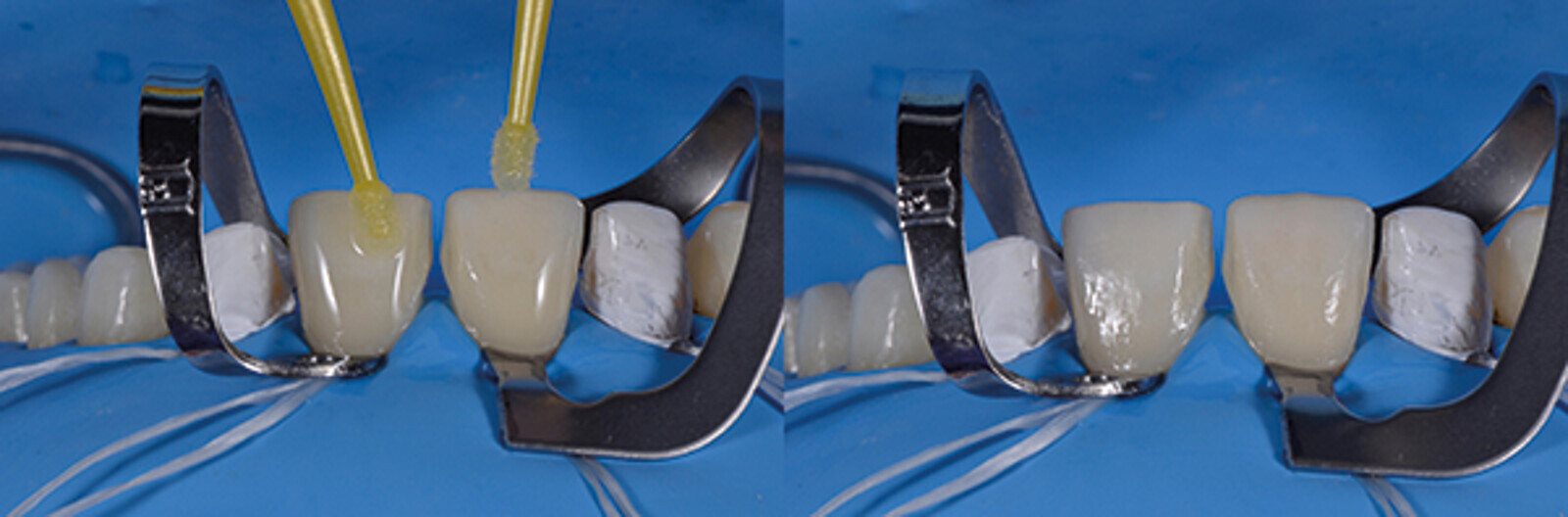 Fig. 16c. Aplicación del agente adhesivo.