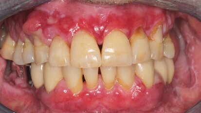 Tratamiento de paciente con trasplante e hiperplasia gingival