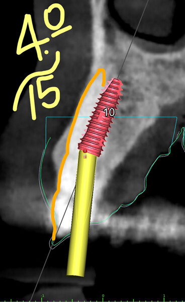 Fig. 7d: Implant in position #22.