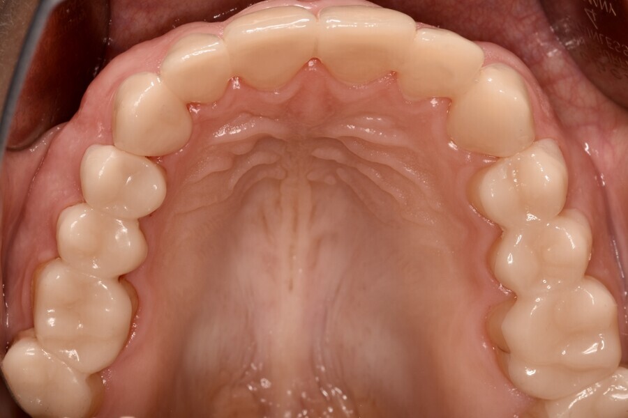 Fig. 11d: Temporarily cemented long-term provisional restorations. Occlusal view of the maxilla.