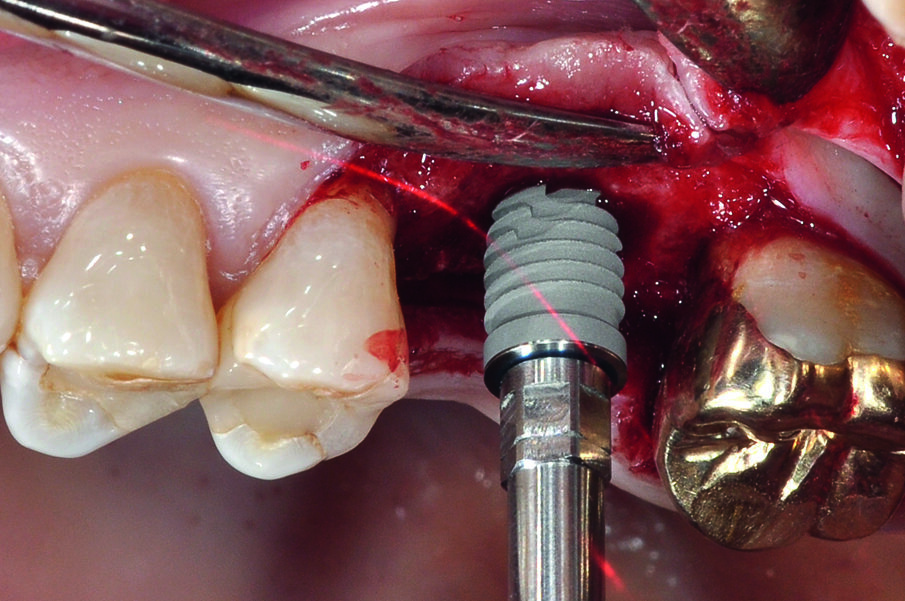 Fig. 4: The implant is inserted into the prepared bone bed.