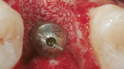 Impianti post-estrattivi immediati