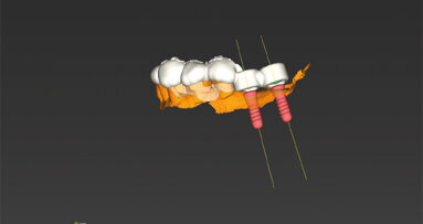 Digitalizace vaší implantologické praxe