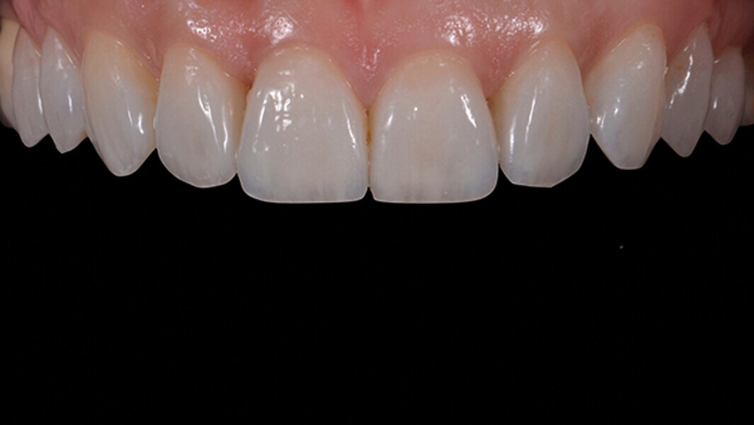 Fig. 17a. Resultado final una semana después.