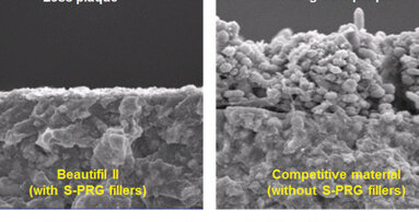 Beautifil II, un composite bioactivo y biomimético que libera fluoruro