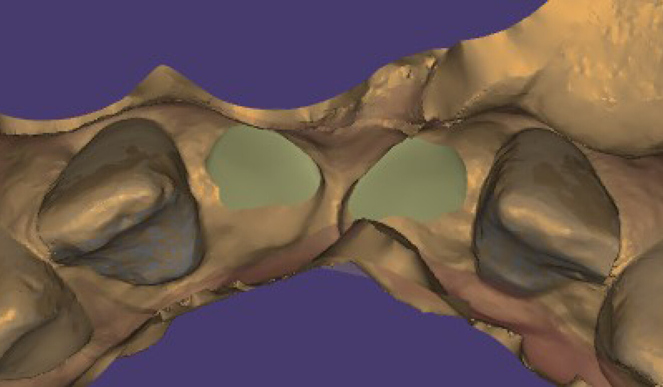 Fig. 5: View of the soft tissue underneath the bridge, showing slight gingival compression.