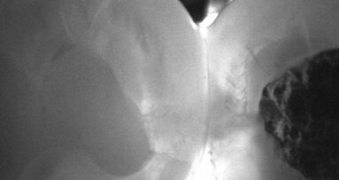 Webinar thematisiert röntgenfreie Kariesdiagnostik