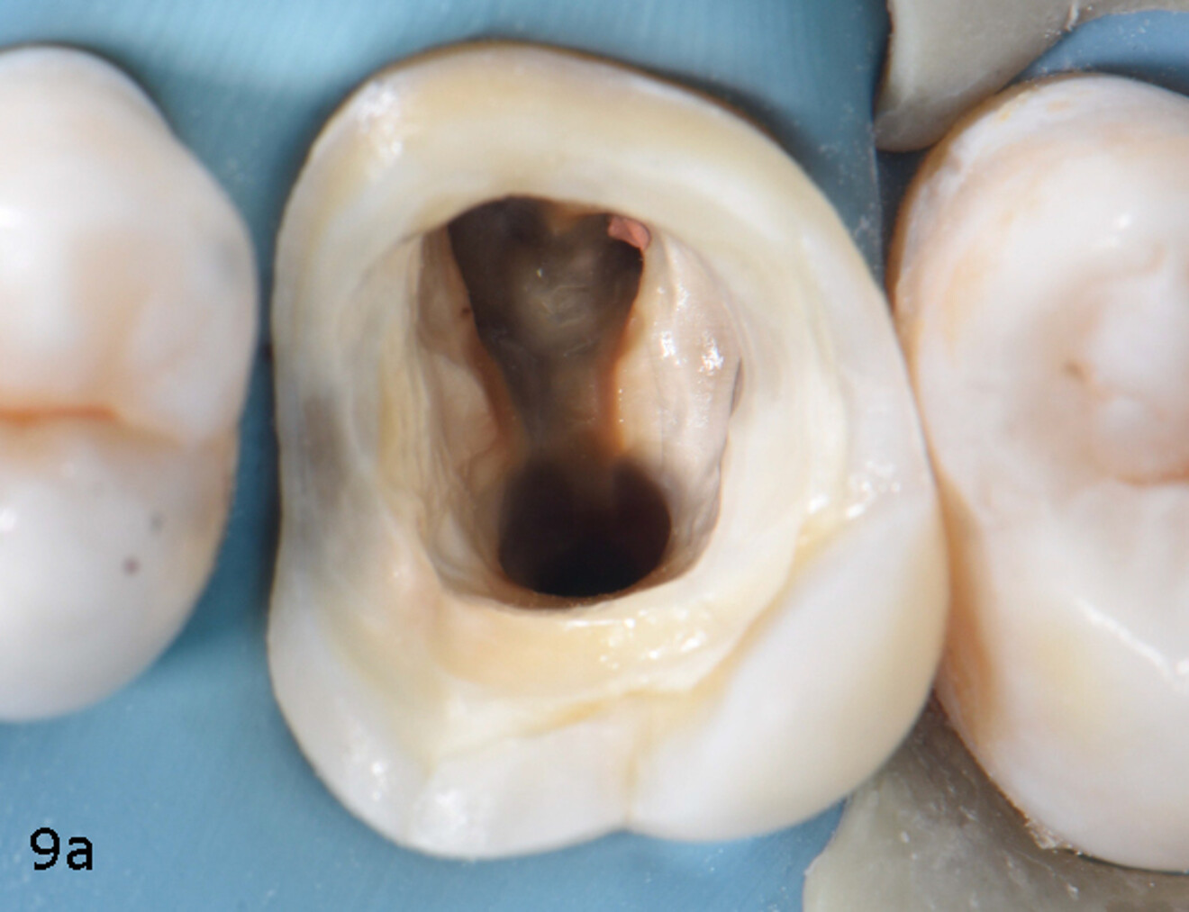 Fig. 9a & b: Immediate dentine sealing before endodontic treatment using CLEARFIL SE Protect Primer (a), followed by CLEARFIL SE Protect Bond (b).