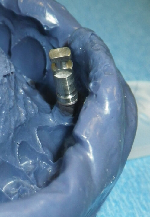 Fig. 14: Place an implant lab analog into impression coping and secure with the screw. The impression is now ready to be sent to the dental laboratory for pour up and crown fabrication. Note the incredible detail and accuracy seen in the 3M™ Impregum™ Soft Polyether Impression Material.