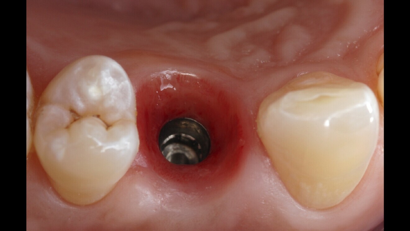 Fig. 4: Soft-tissue maturation three months after immediate provisional restoration in region #14.