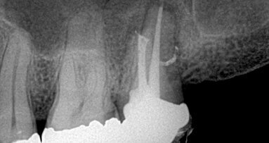 Efekat primene parcijalnog vakuuma na hemijsku obradu sistema kanala korena: Sleimanova faza