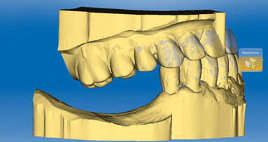 Efficienza del flusso digitale nelle riabilitazioni implantoprotesiche: Virtual Rehabilitation Concept (VRC)