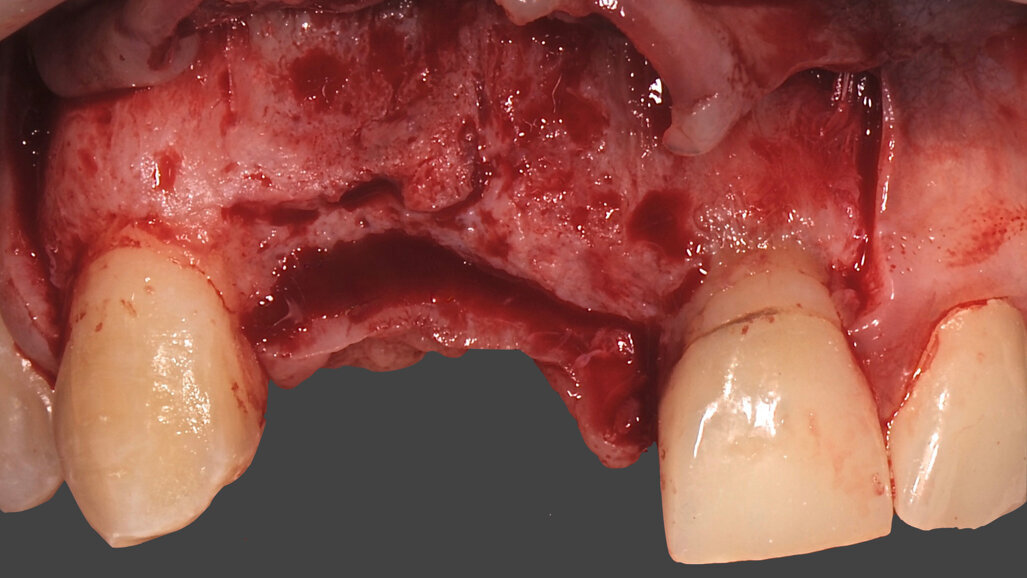 L’aumento del tessuto osseo nei settori estetici con utilizzo di griglie customizzate e Geistlich Mucograft
