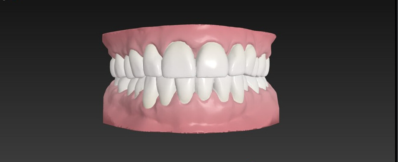 Fig. 4: Initial ClearCorrect treatment set-up. Anticipated treatment results after 12 steps of aligner treatment.