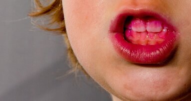 Tandplaque wellicht bruikbaar in strijd tegen gaatjes en tandvleesontstekingen