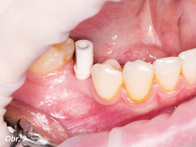 Za účelem navržení náhrady byl na implantát umístěn skenovací abutment.