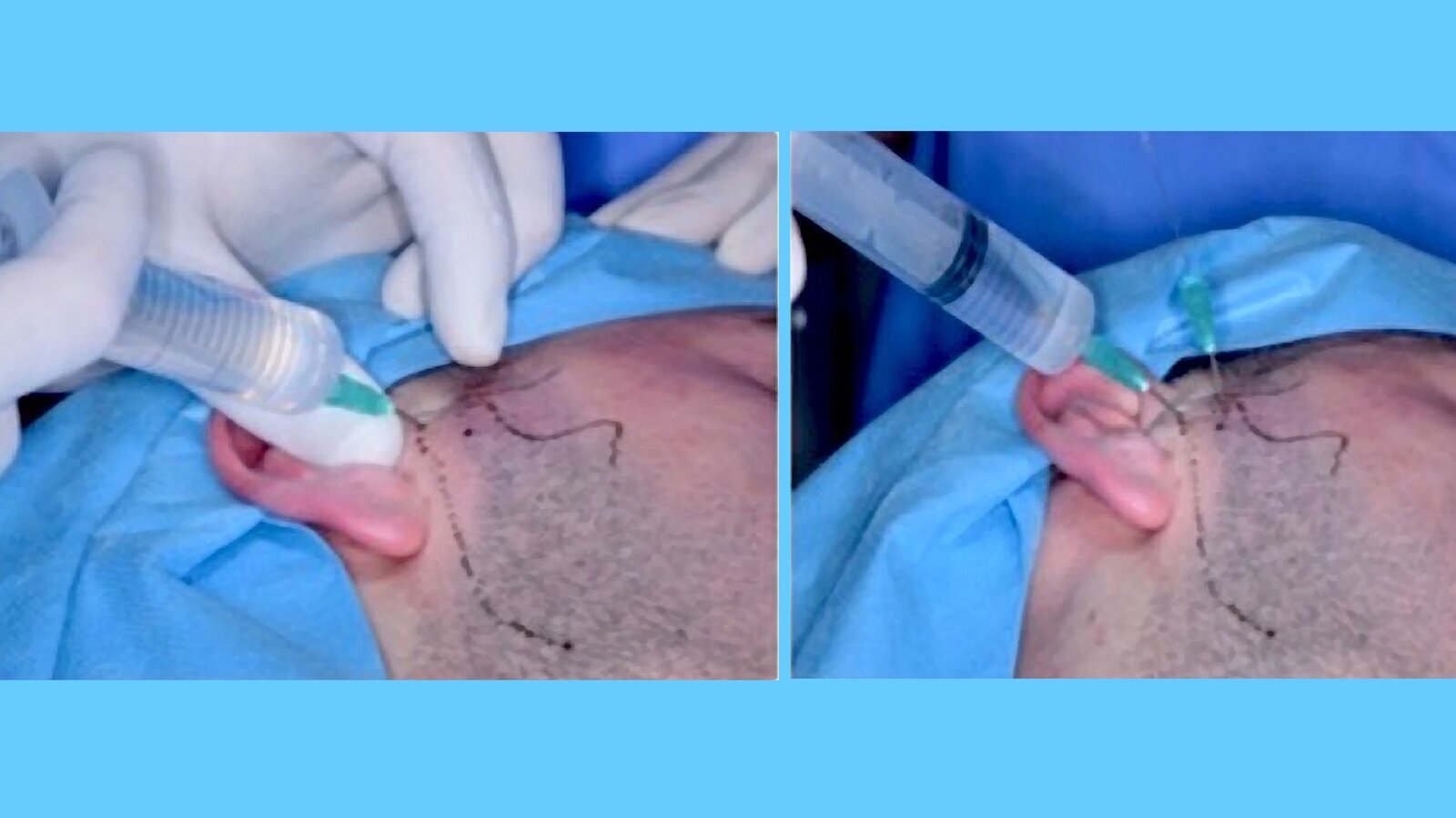 Tratamiento quirúrgico mínimamente invasivo de la ATM (1)