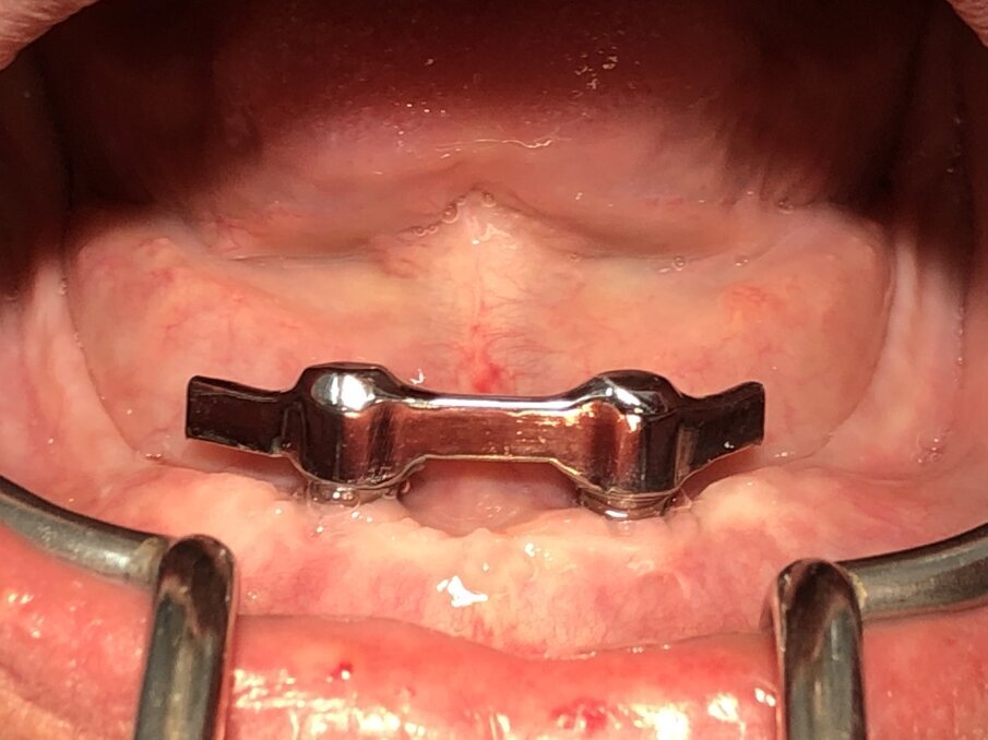 Afbeelding 9. Gefreesde staaf in mond.