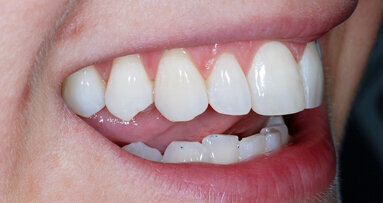 Upper Arch Alignment with  the ClearSmile Inman Aligner