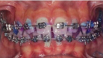 La terapia proattiva nel mantenimento del paziente ortodontico parodontale