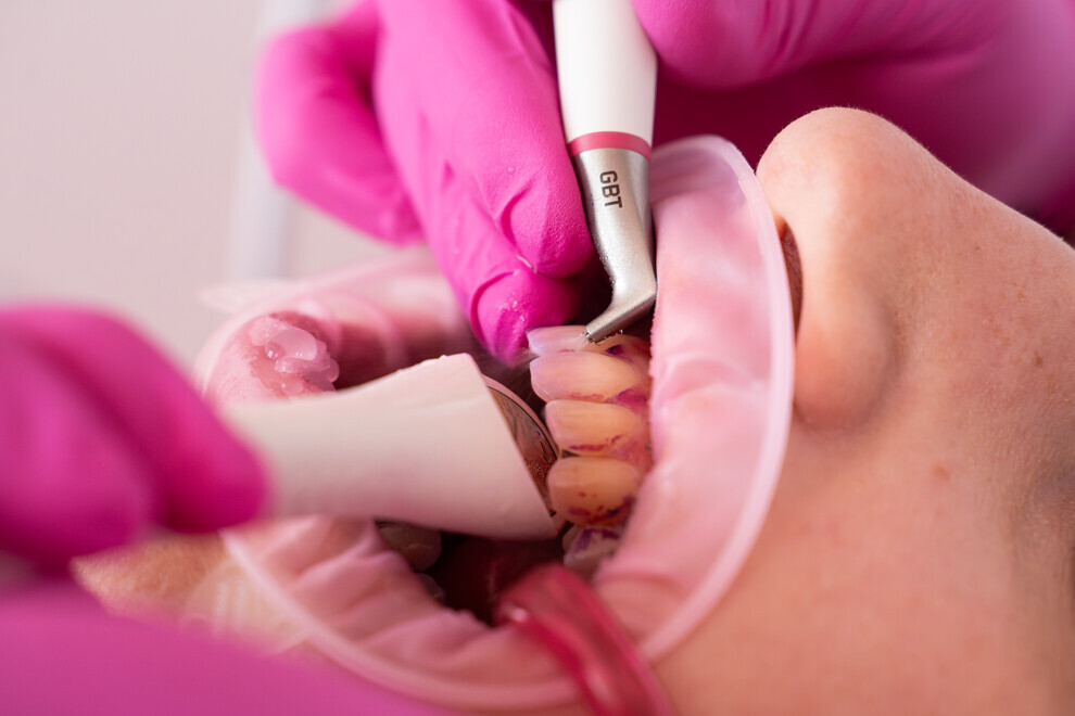 State-of-the-art dental prophylaxis with AIR-FLOWING. This effective yet gentle method is ideal for managing biofilm on all oral tissue, as well as implants and restorations.