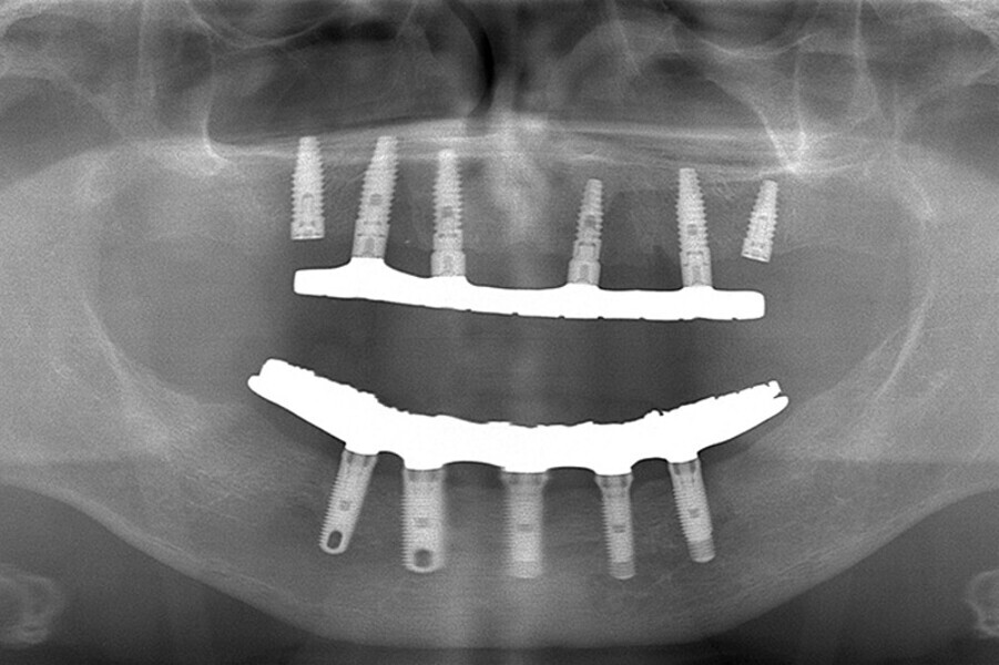Fig. 20. Prótesis híbrida inmediata con 7 años de evolución y Rx Control a los 7 años.