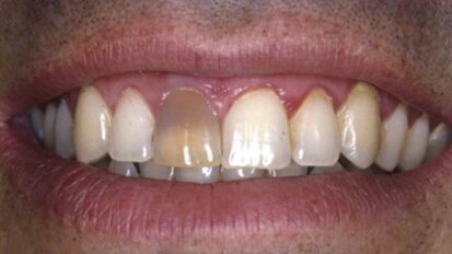 Estética y blanqueamiento dental en la era digital  (Capítulo 7)