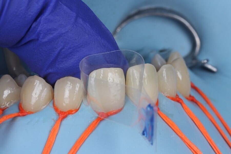 Fig. 3c: The clear matrix placed using the haji matrix technique.