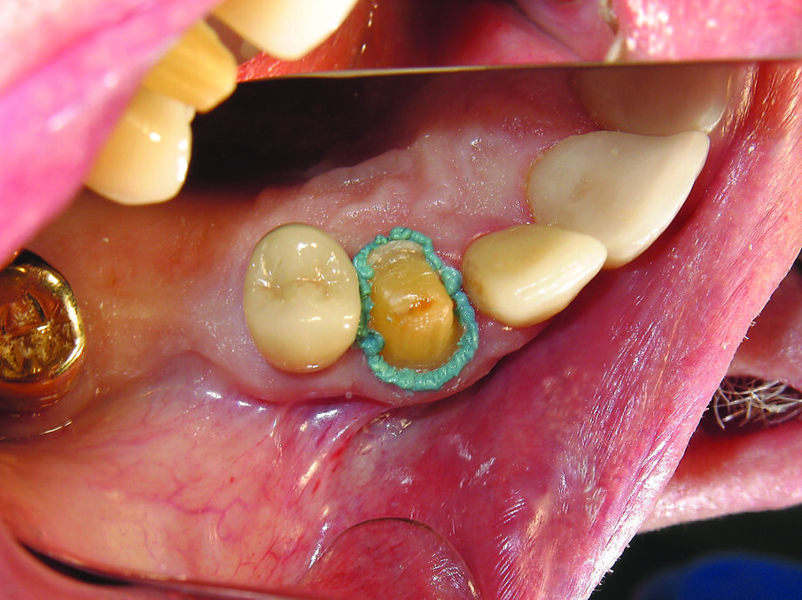 Fig. 2. 3M retraction paste in place around preparation