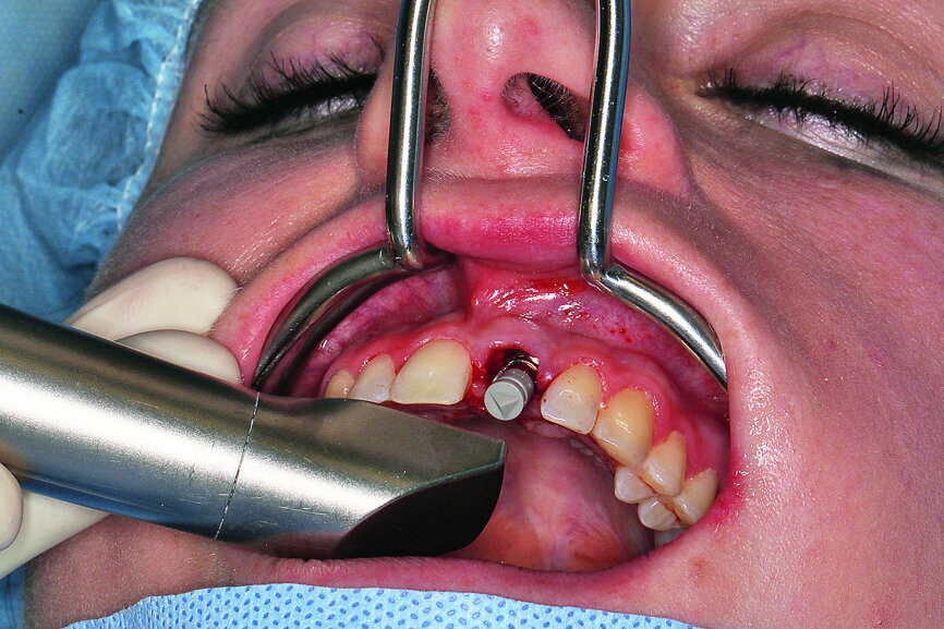 Fig. 10: Intra-op CEREC scanning with a ScanPost.