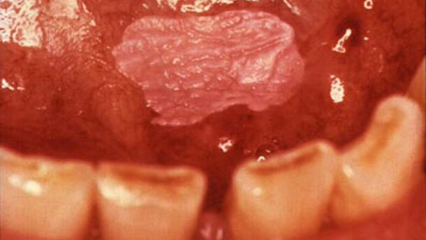 Mondonderzoek spoort orale kanker niet tijdig op