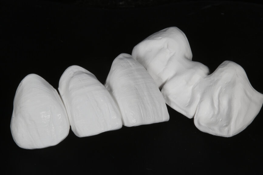 Fig. 8: Milled monolithic restorations with a pronounced surface texture.