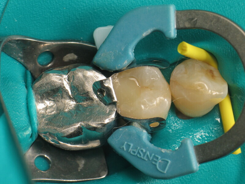 Fig. 12 : Application du VisCalor Bulk.