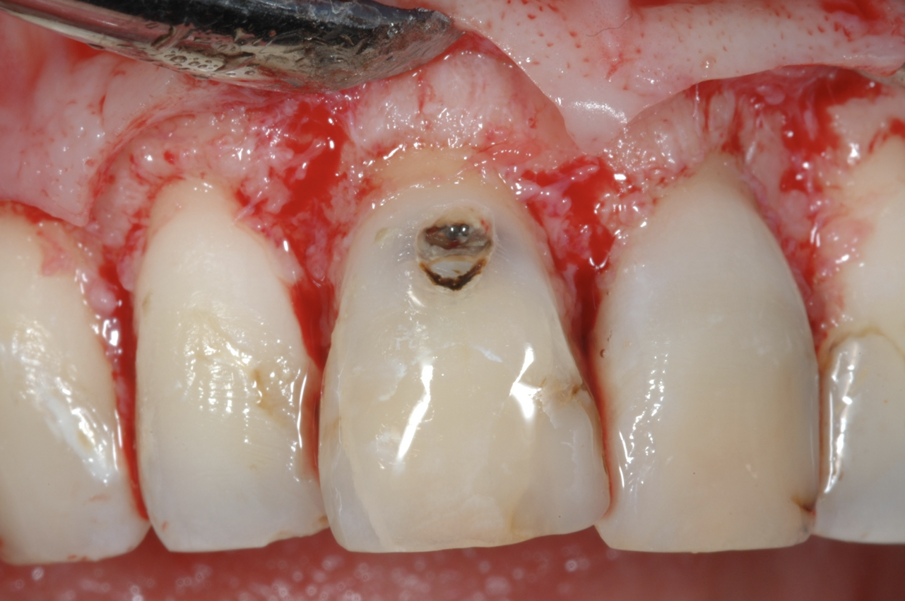 Fig. 5 - Il rapporto tra lesione cariosa e tessuto osseo di sostegno appena sollevato il lembo.
