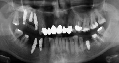 Guarire meglio, più rapidamente e con meno dolore con il PRGF