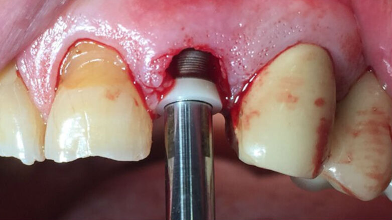Mantenimento del trofismo connettivale in regione estetica con utilizzo di impianti ibridi