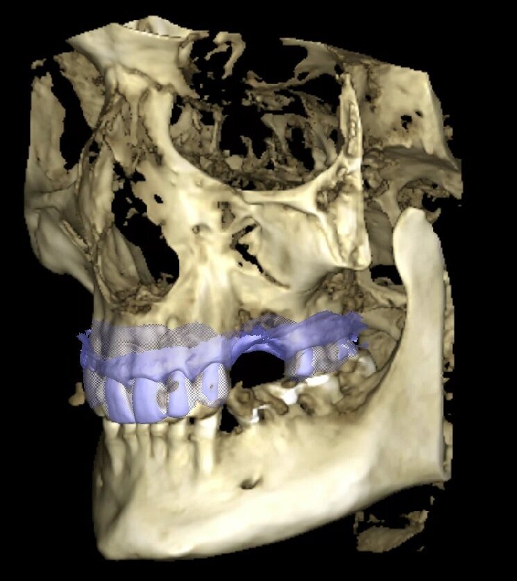 Fig. 3_Volume rendering con sovrapposizione dell’impronta intraorale in formato STL.
