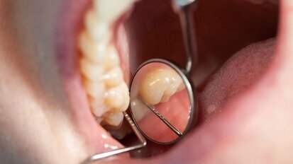 Commentaar gevraagd op conceptrichtlijn Derde molaar