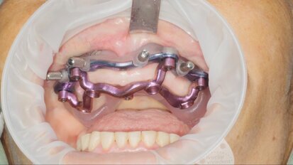 Il Posizionamento Protesico Pianificato  nelle riabilitazioni full arch: Pcube Technique