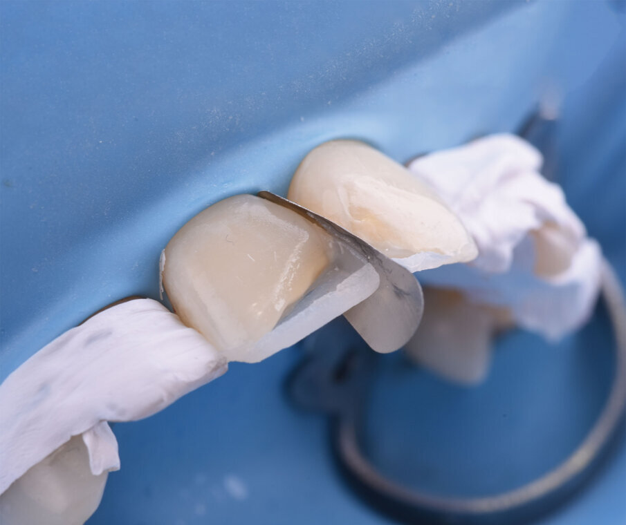 Sl. 10a: Modelovanje aproksimalnog zida restauracije