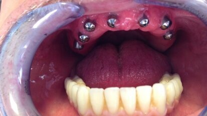 Złożone leczenie implantoprotetyczne bezzębia