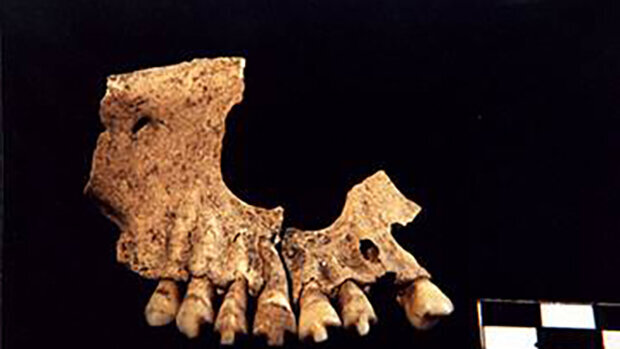 Βρέθηκε οδοντική έμφραξη από τη λίθινη εποχή